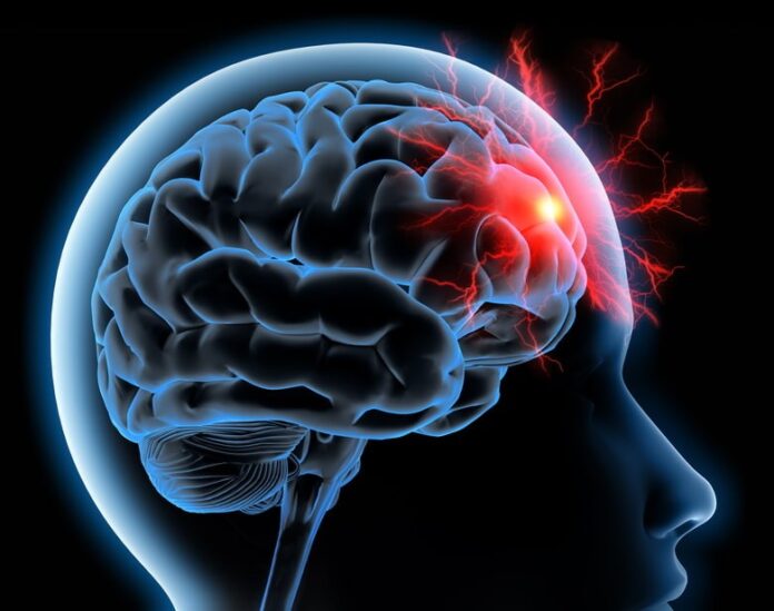 AVC Lutte contre les AVC : le Maroc passe à l’action